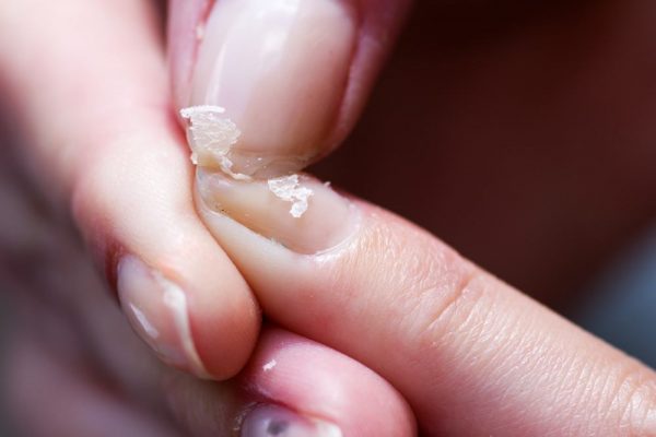 The Connection Between Iron Deficiency and Nail Brittleness